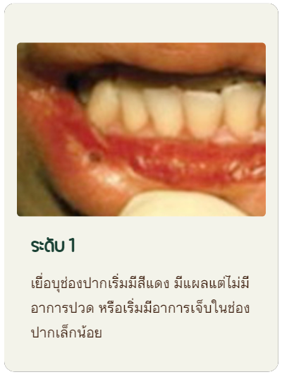 ระดับ 1 เยื่อบุช่องปากเริ่มมีสีแดง มีแผลแต่ไม่มีอาการปวด หรือเริ่มมีอาการเจ็บในช่องปากเล็กน้อย