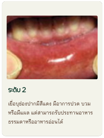ระดับ2 เยื่อบุช่องปากมีสีแดง มีอาการปวด บวม หรือมีแผล แต่สามารถรับประทานอาหารธรรมดาหรืออาหารอ่อนได้