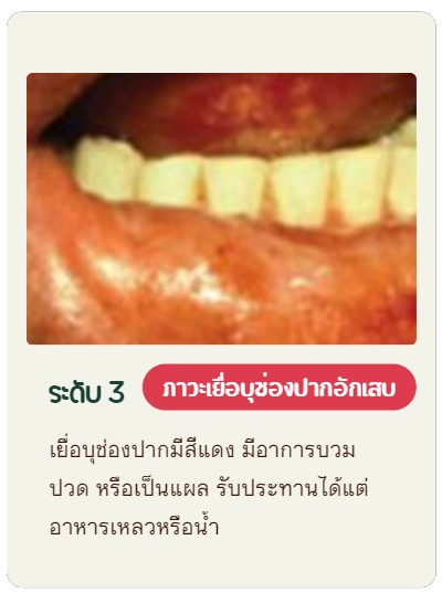 ระดับ3 เยื่อบุช่องปากมีสีแดง มีอาการบวม ปวด หรือเป็นแผล รับประทานได้แต่อาหารเหลวหรือน้ำ
