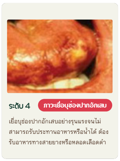 ระดับ4 เยื่อบุช่องปากอักเสบอย่างรุนแรงจนไม่สามารถรับประทานอาหารหรือน้ำได้ ต้องรับอาหารทางสายยางหรือหลอดเลือดดำ
